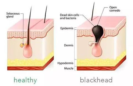 黑頭總是去不掉？這可能是 全 有效的去黑頭指南了！