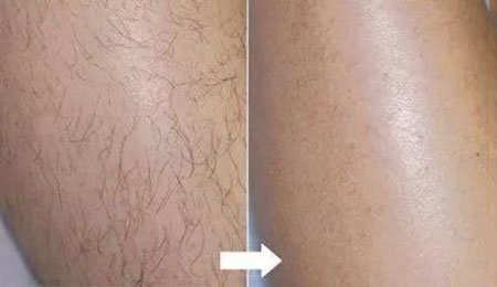 春季不脫毛，夏季獼猴桃！現(xiàn)在是脫毛的 佳時(shí)機(jī)~