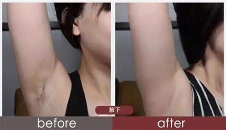 春季不脫毛，夏季獼猴桃！現(xiàn)在是脫毛的 佳時(shí)機(jī)~