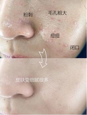 被粉刺、黑頭、毛孔、角質糾纏？千萬別忽視深層清潔！