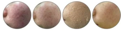 海藻煥膚修復(fù)的過程