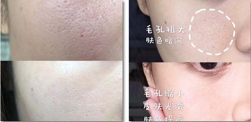 收縮毛孔、祛除皺紋