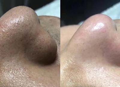 智能光電美膚VC美白+補(bǔ)水組合管理