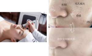 如何去黑頭？為什么要定期做去黑頭管理？VN給你好的答案